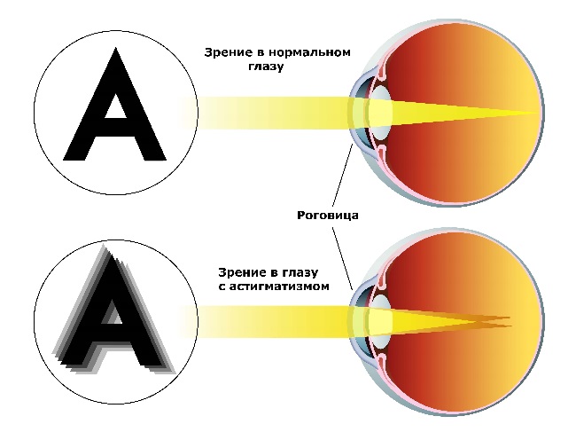 Линзы для астигматизма фирмы